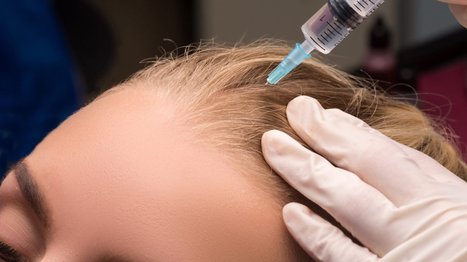 Hair mesotherapy for hair loss Dubai treatment session